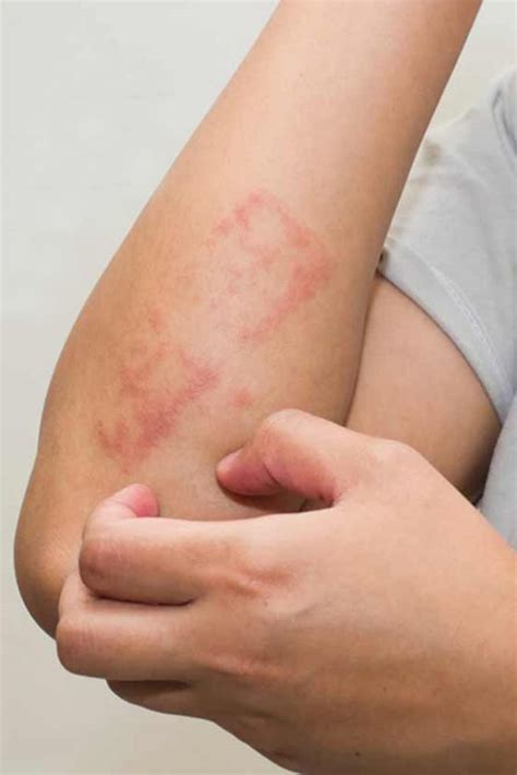 Sweat Rash Treatment And Prevention Tips