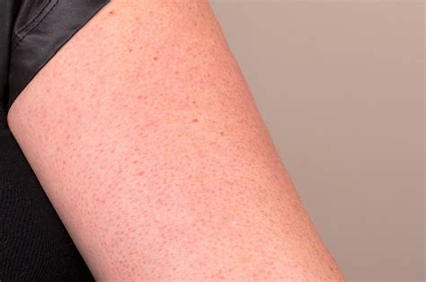 How To Treat Keratosis Pilaris Those Scaly Red Bumps On Your Upper