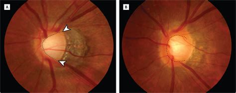 Novel Screening Method For Glaucomatous Eyes With Myopic Tilted Discs
