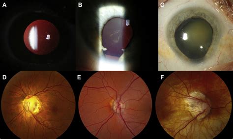 Ocular And Systemic Findings In Adults With Uveal Coloboma Ophthalmology