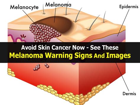 How Can Doctors Tell If You Have Skin Cancer Bestabstractvenue