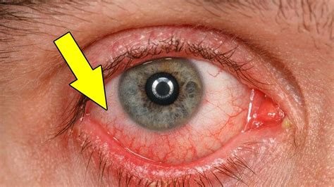 How To Get Rid Of Red Eyes Quickly At Homehome Remedies