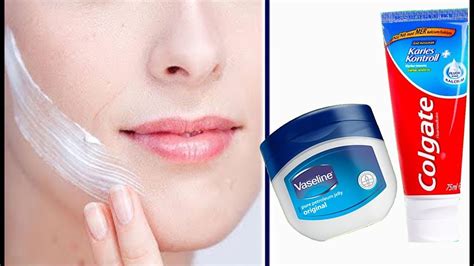 Vaseline And Toothpaste To Get Rid Of Pimples Easily Vaseline Youtube