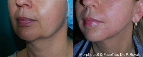 Morpheus8 Non Surgical Treatment London Premier Laser Clinic