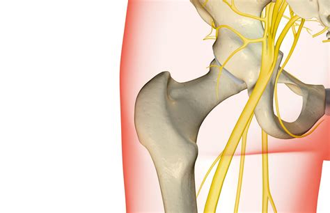 We did not find results for: Exercise for Sciatica Related to Herniated Disc