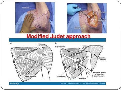 Scapula Fracture Diagnosis And Management