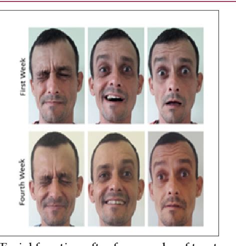 Figure 1 From Treatment Of Bell Palsy Using Facial Exercises In Primary