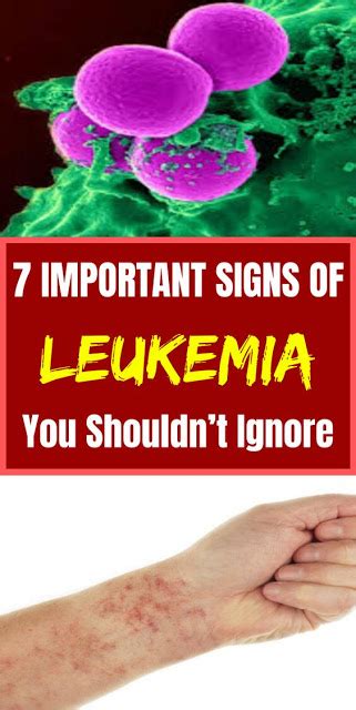 7 Important Signs Of Leukemia You Shouldnt Ignore Medicine Health Life
