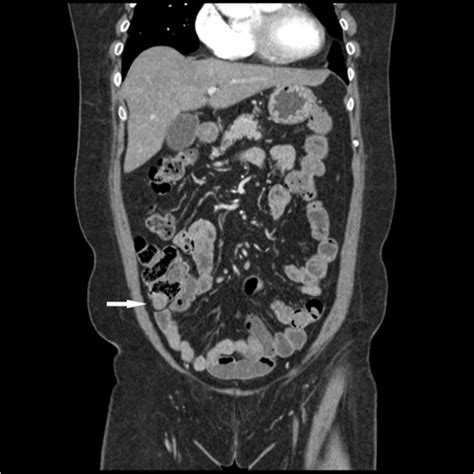 Figure Abdominal Ct Coronal Image Showing An Enhancing Mass In The My