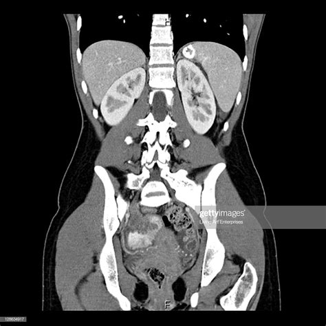 This Coronal Ct Scan Of The Lower Chest Abdomen And Pelvis Demonstrates