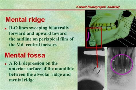 Normal Radiographic Anatomy Based On Intraoral Films Teeth