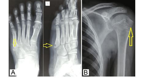 X Ray Of The Right Foot Showing A Geographic Lytic Lesion With