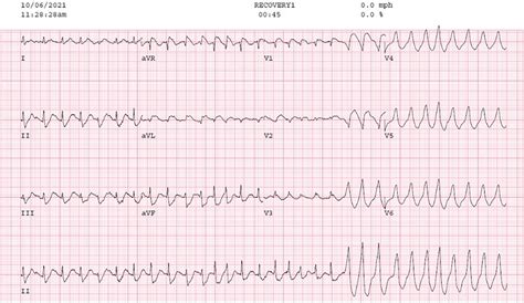 Ekg Showing Initiation Of Nsvt Irregular Wide Qrs Tachycardia With