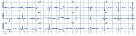 Rest Ecg Showing Normal Sinus Rhythm With A Heart Rate Of 60
