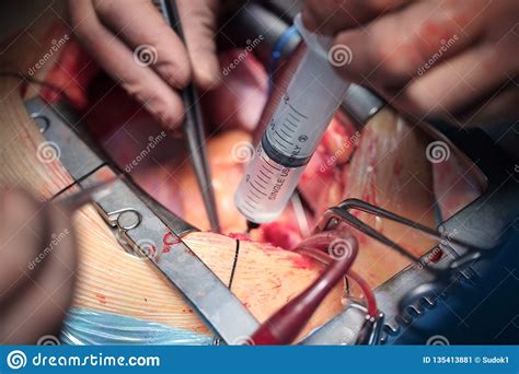 Stage Of Open Heart Surgery Stock Image Image Of Close Sterility
