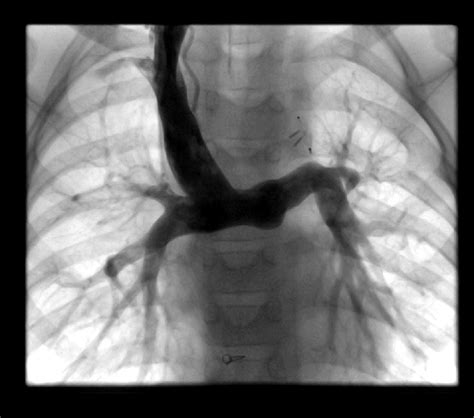 A 6 Year Old Patient After A Glenn Procedure The Additional Left