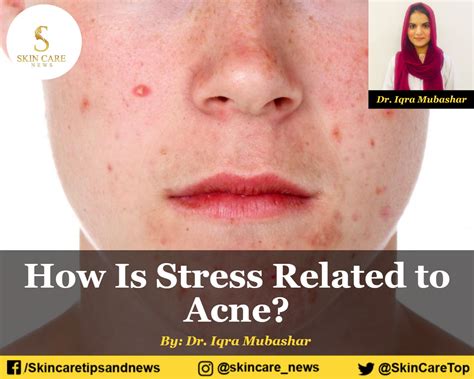 How Is Stress Related To Cause Of Acne Breakouts