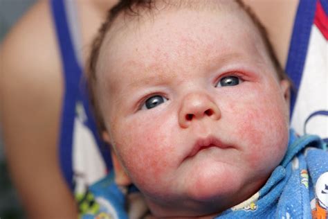 How To Treat A Baby Rash According To Experts