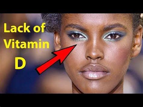 5 Unusual Signs And Symtoms That Youre Lacking Vitamin D Vitamins