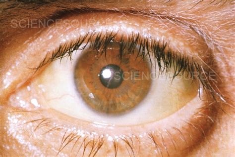 Jaundice In Eye Stock Image Science Source Images