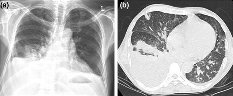 A Chest X Ray PA View Showing Pleural Effusion And B HRCT Of The