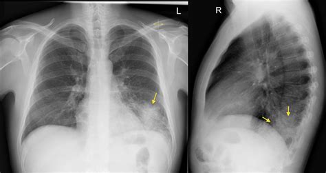 Left Lower Lobe Pneumonia Lateral CXR Radiology At St Vincent S University Hospital