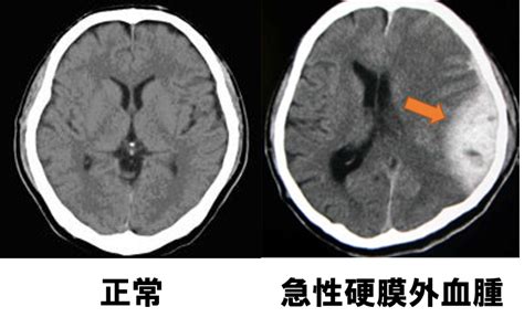 Mousou kanshou daishou renmeisimplified chinese: 国家試験対策をしよう!!～頭部CT画像症例～ | ギモンらど!!