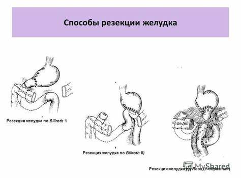 Диета послеоперационная при резекции желудка Диета После Резекции Желудка По Бильрот 2 — Похудение Диета Правильное Диета После Резекции Желудка По Бильрот 2 — Похудение Диета Правильное Диета послеоперационная при резекции желудка