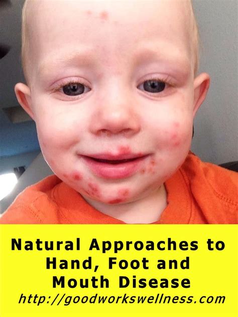 The Cdc Is Predicting Higher Rates Of Hand Foot And Mouth Disease This