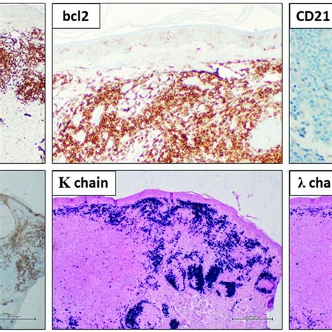 Primary Cutaneous Marginal Zone Lymphoma Immunohistochemical Findings