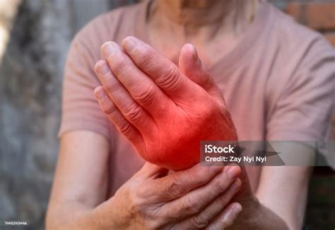 Hand Joints Inflammation Concept Of Rheumatic Arthritis Rheumatism Gout