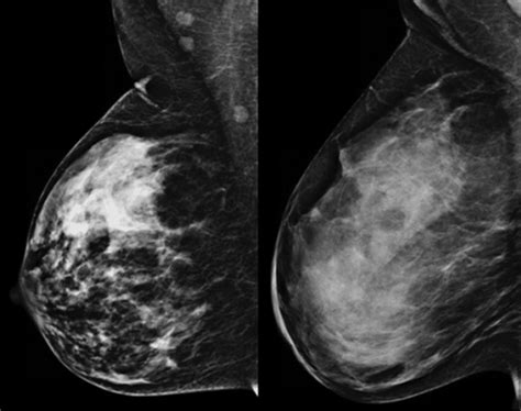 What Is Breast Density And Why Is It Important Radiology Of Indiana