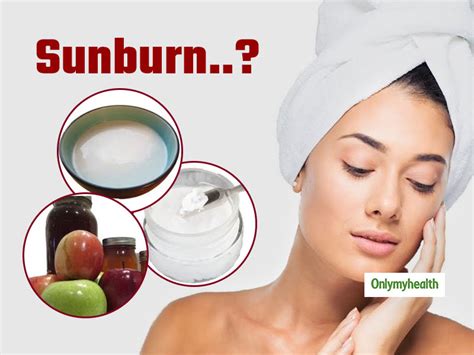 Natural Home Remedies For Sunburn 6 Best Tips To Cool Down Your Skin