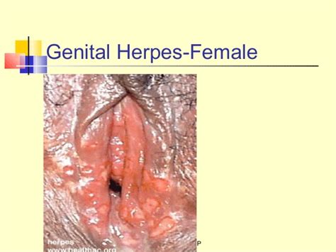 The female condom in fact may be a superior form of protection because it. Genital Herpes Symptoms In Women Mild Anemia Icd — Herpes Free Me