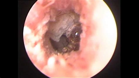 Chronic Ear Infection2 - YouTube