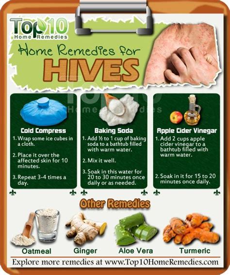 Home Remedies For Hives Top 10 Home Remedies Home Remedies For