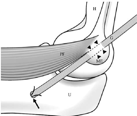 Ulnar Collateral Ligament Reconstruction With The Modified Jobe