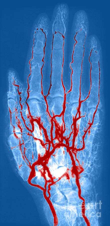 Hand Arteriogram Photograph By Science Source Fine Art America