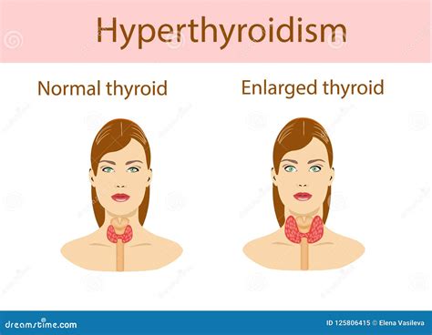 Woman With Enlarged Hyperthyroid Gland Vector Illustration Stock