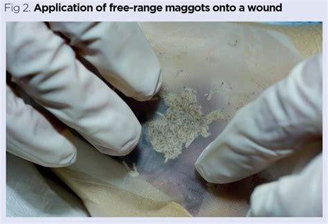 The Principles Of Maggot Therapy And Its Role In Contemporary Wound