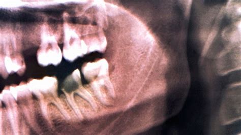 Maybe you would like to learn more about one of these? BBC - Earth - How our ancestors drilled rotten teeth