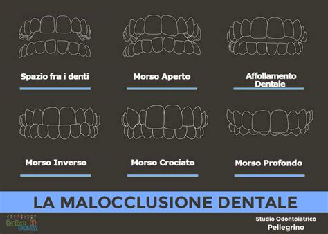 La Malocclusione Dentale Cos E Da Cosa Deriva Blog Studio Pellegrino