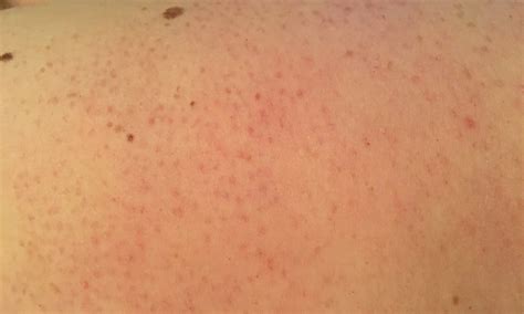 Chicken Skin Keratosis Pilaris How To Get Rid Of Tiny Red Dots On