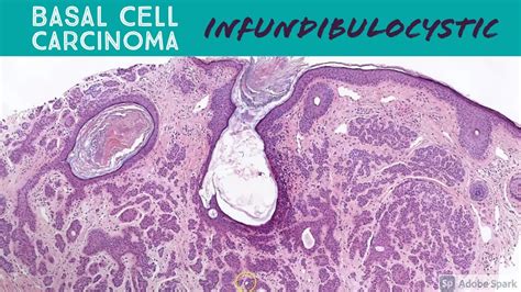 Superficial Basal Cell Carcinoma Histology