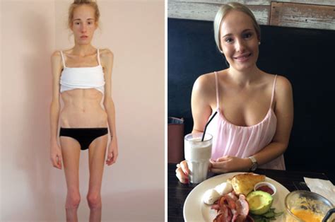 Recovered Anorexic Given Just Hours To Live Shares Harrowing Photos Of St Figure Daily Star