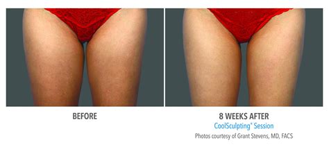 3 ways to get a thigh gap how to get a thigh gap with coolsculpting and emsculpt neo the