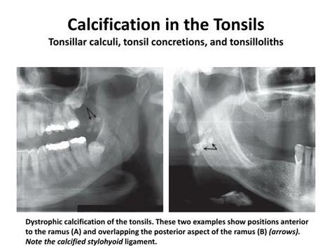 Ppt Soft Tissue Calcification And Ossification Powerpoint