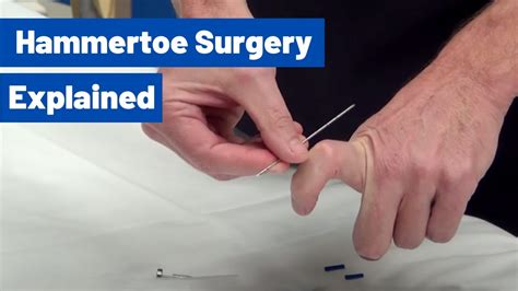 Hammertoe Surgery Explained By Dr Moore Using An Internal Pin