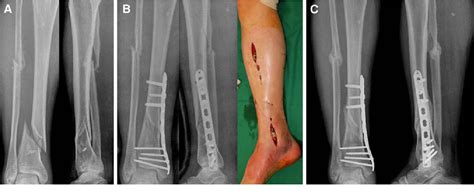 Pdf Minimally Invasive Plate Osteosynthesis Of Distal Tibial Fracture