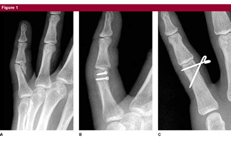 Fractures Of The Proximal Phalanx And Metacarpals In The Hand
